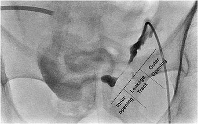 NBCA-Lipiodol Mixture Embolization of Persistent Urine Leakage After Orthotopic Neobladder Formation: Techniques and Outcomes